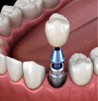 Illustrated dental crown being placed over a dental implant