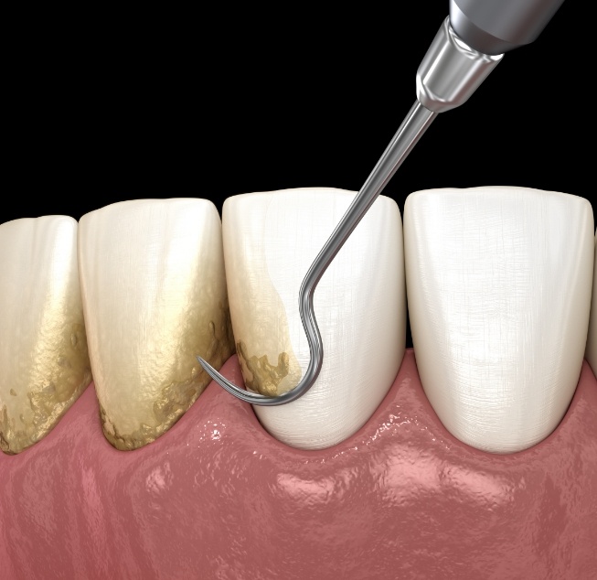 Illustrated dental scaler removing plaque buildup from teeth during gum disease treatment