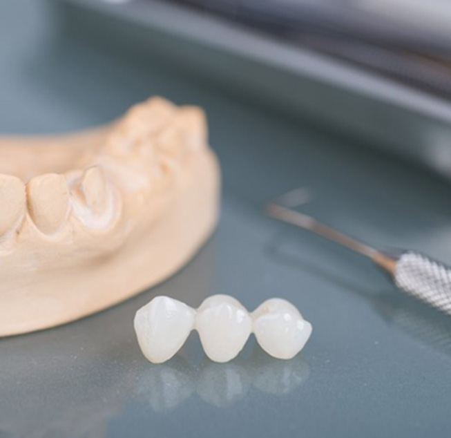 Dental bridge sitting next to a plaster model of an lower arch