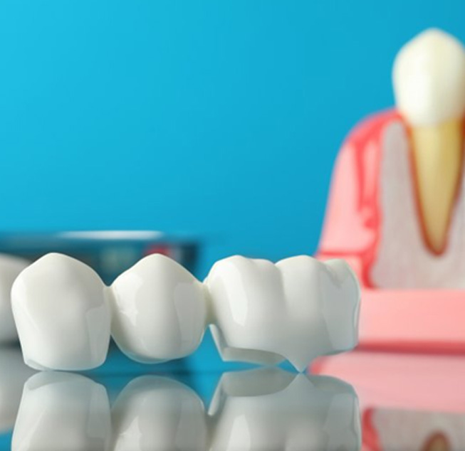 A dental bridge sitting on a clear surface with a model dental implant in the background