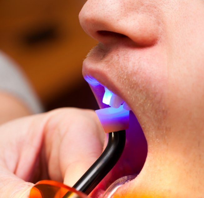 Close up of dental patient getting direct bonding on upper front tooth