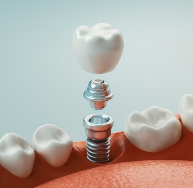 Illustration of dental implant in Hanford being placed in lower jaw