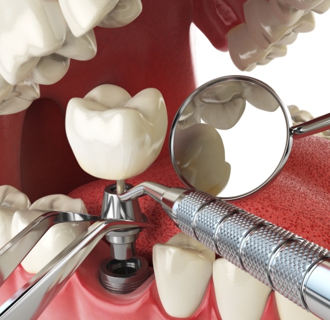 Illustrated dental implant with crown and abutment being placed