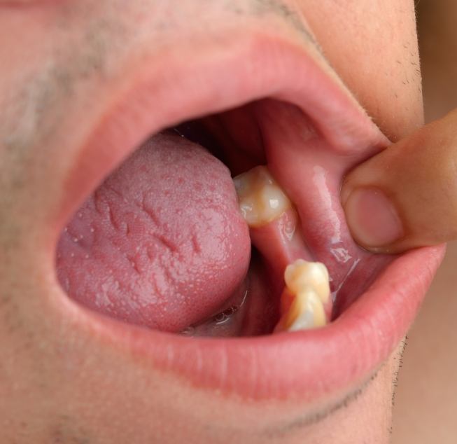 Close up of mouth with a missing tooth