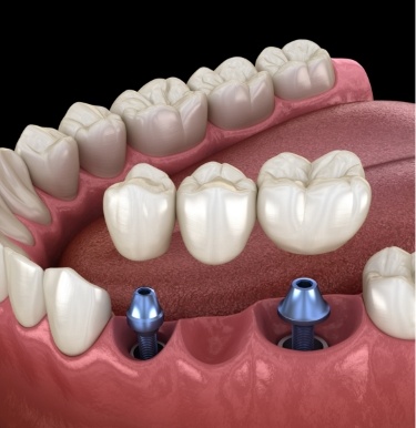 Illustrated dental bridge being placed over two dental implants