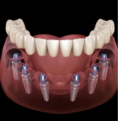 Illustrated full denture being placed over six dental implants