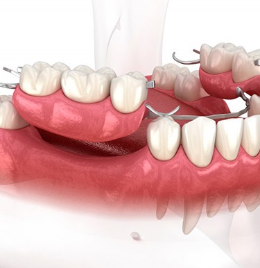 Illustration of partial denture