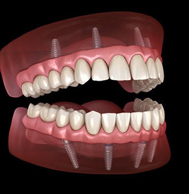 Illustration of implant dentures 