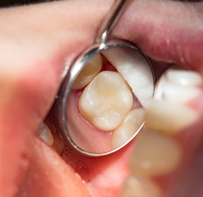Tooth-colored fillings are virtually indetectable 
