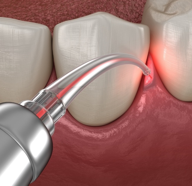 Illustrated dental laser treating gum disease