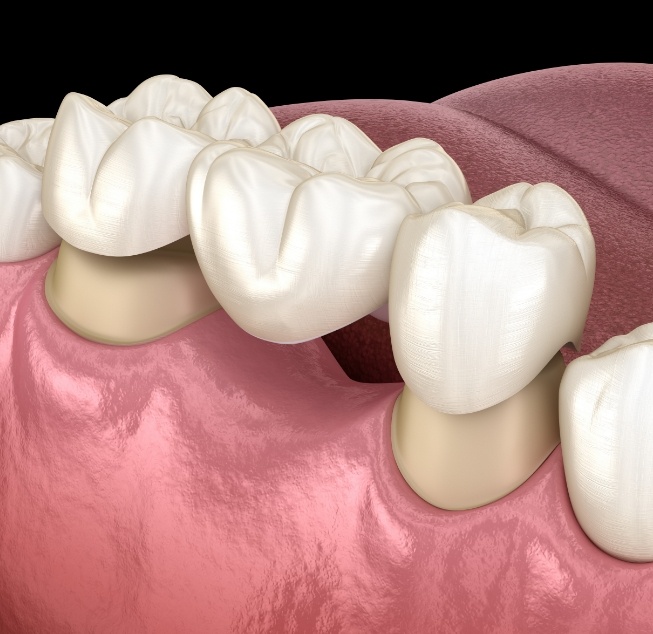 Illustrated dental bridge replacing a missing tooth