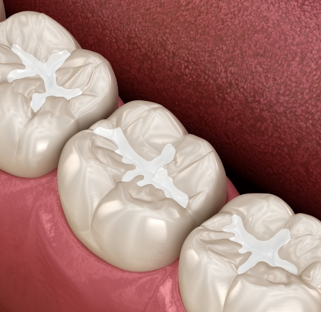 Illustrated row of teeth with white dental sealants