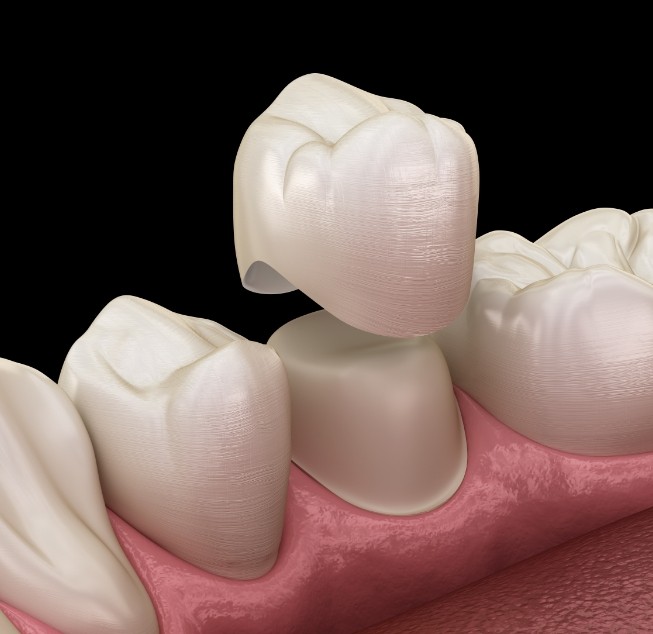 Illustrated dental crown being fitted over a tooth