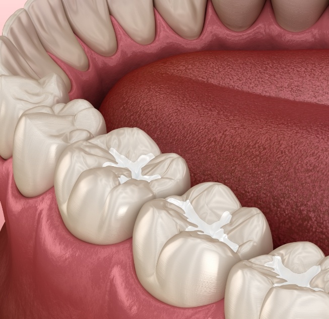 Illustrated row of teeth with white fillings