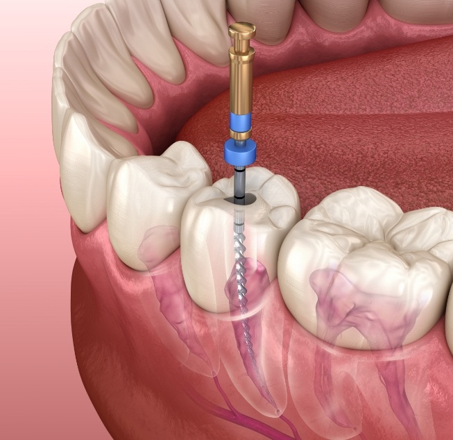 Illustrated dental instrument cleaning the inside of a tooth during root canal treatment