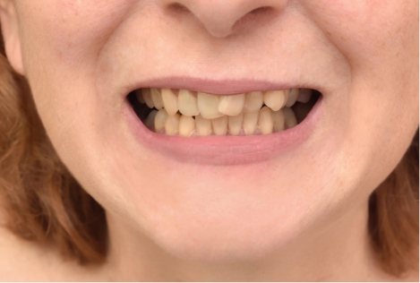 Close up of smile with yellowed and crooked teeth