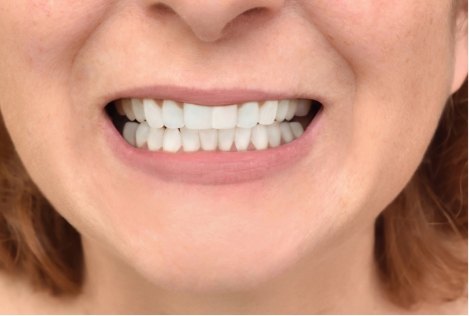 Close up of smile with straight white teeth