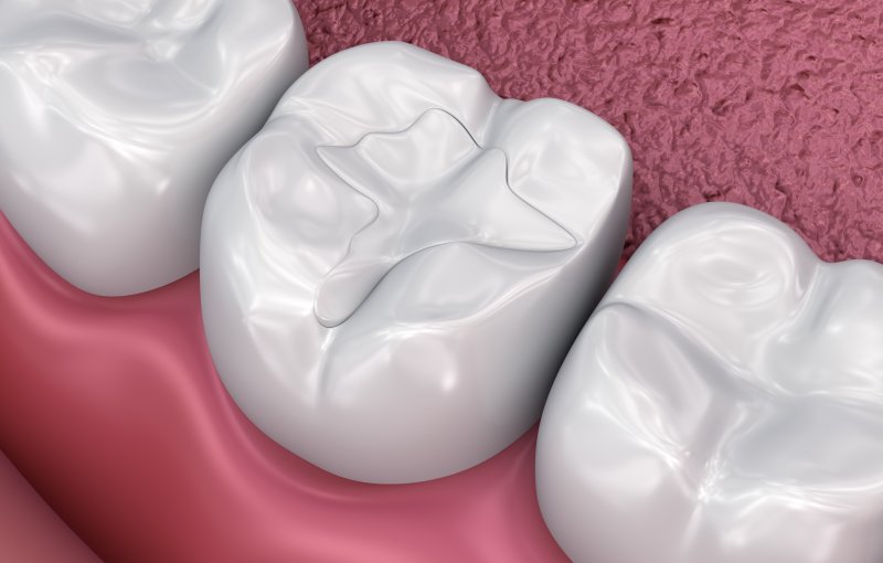 A 3D illustration of a tooth-colored filling