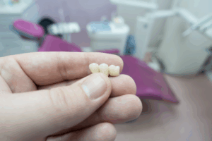 a close-up of a dental bridge