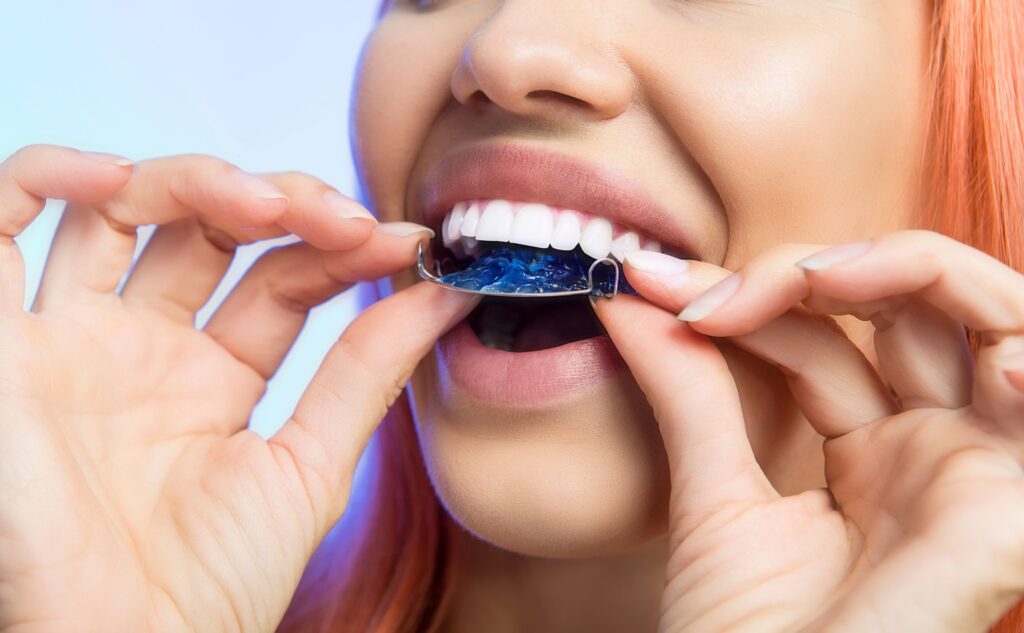 Nose-to-neck view of woman removing blue retainer from upper arch